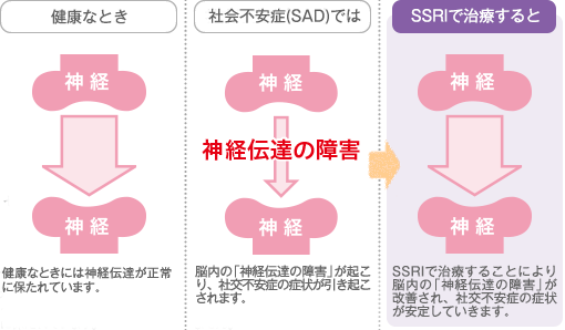 SSRIで治療すると